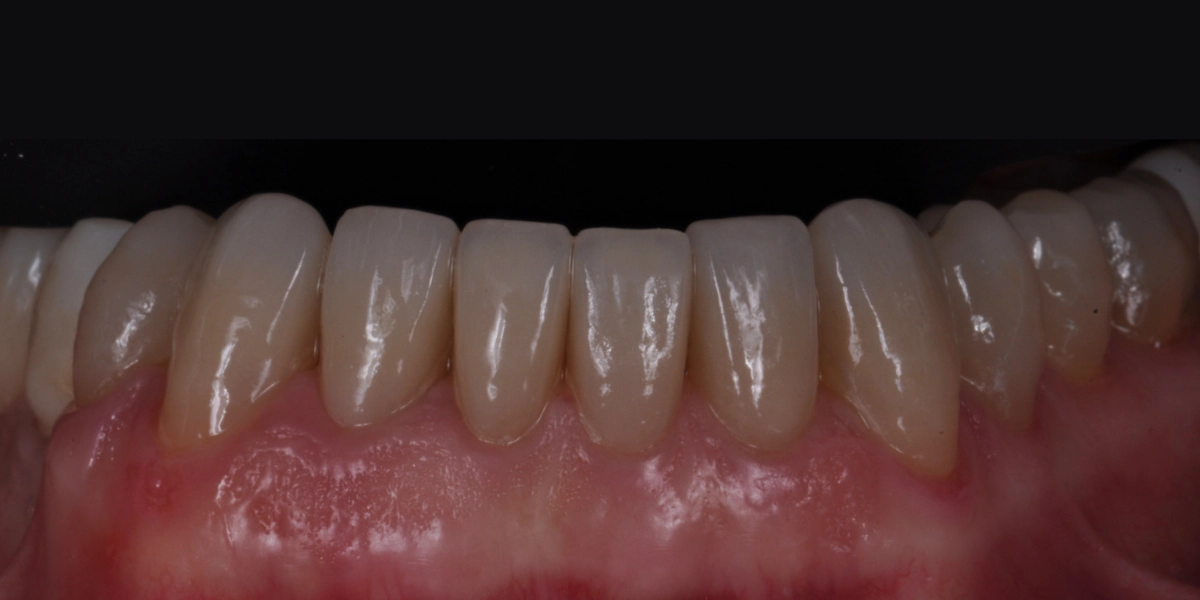 Denti usurati 2 - dopo
