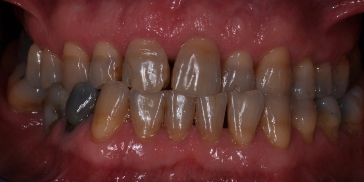 Denti usurati