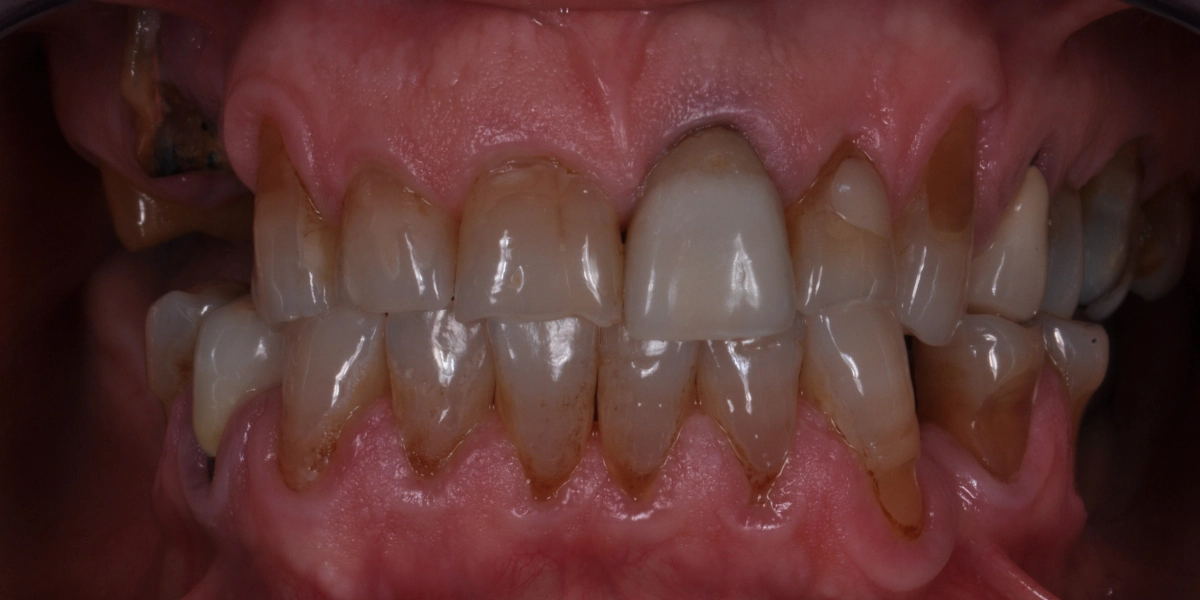 Denti usurati 4 - prima