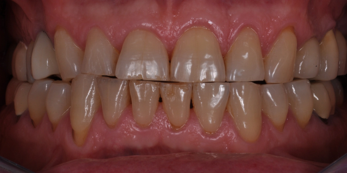 Denti usurati 5 - prima