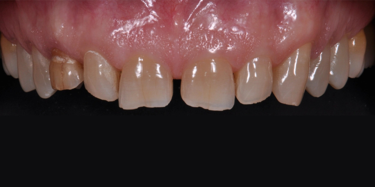 Denti usurati prima