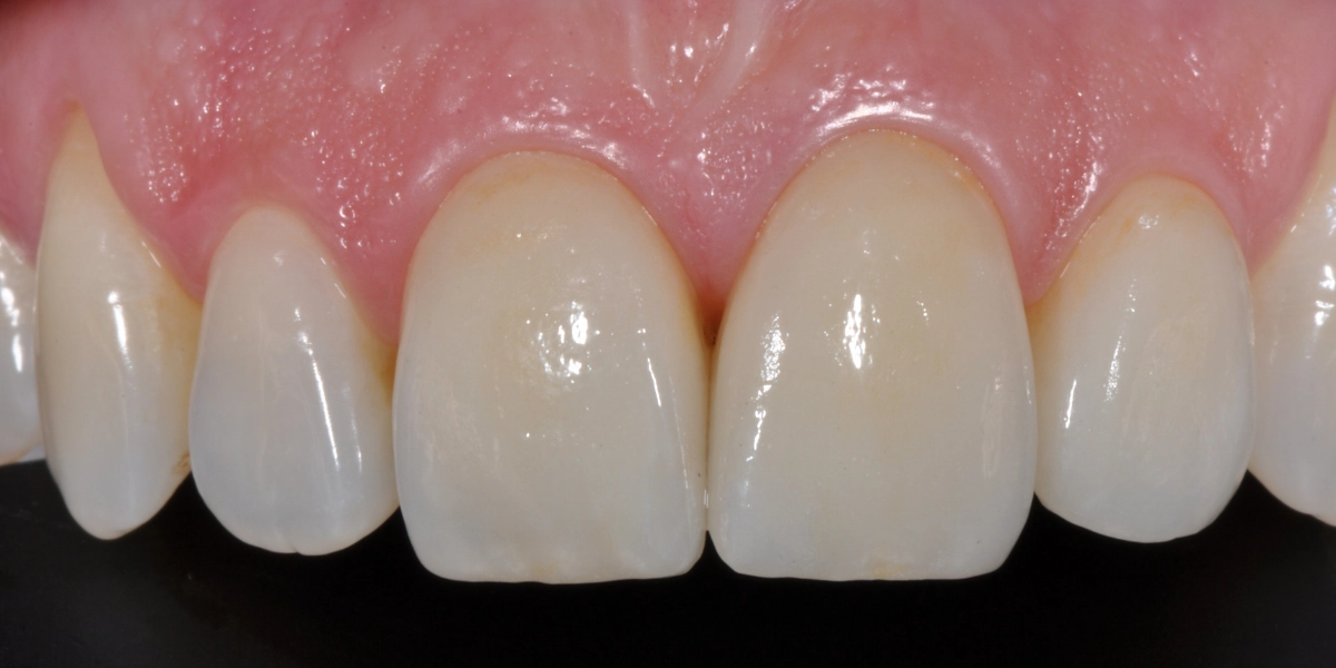 Faccette dentali 2 - dopo