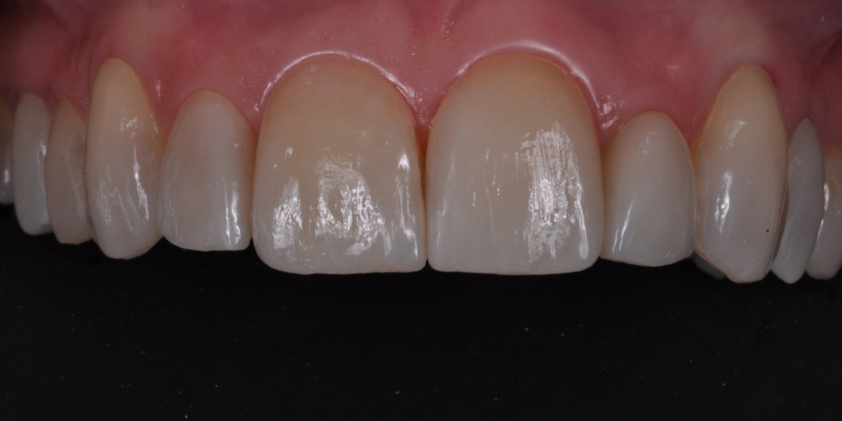Faccette dentali 4 - dopo