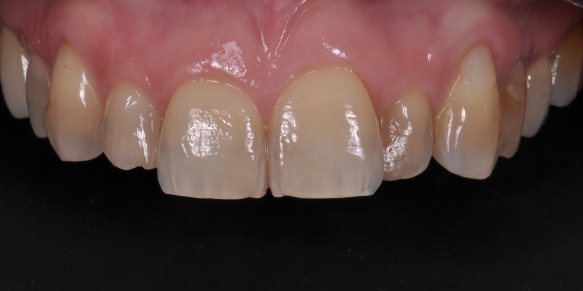 Faccette dentali 4 - prima