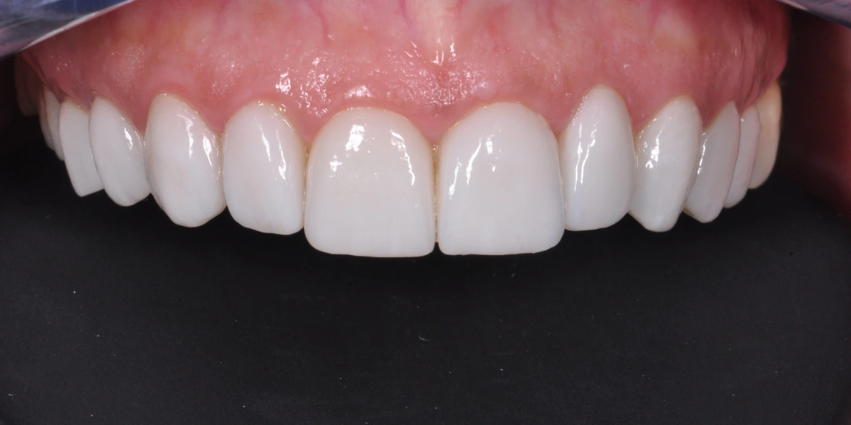 Faccette dentali
