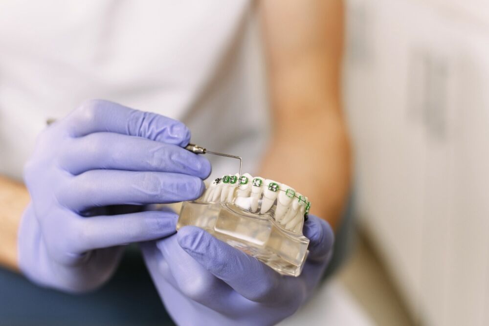 Spostamento dei denti con l'apparecchio: come funziona, passo dopo passo, il percorso per raddrizzare il sorriso 1 spostamento dei denti con l'apparecchio